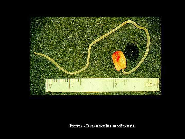 Ришта - Dracunculus medinensis 