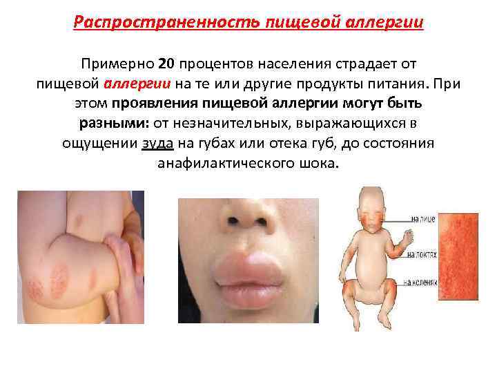 Распространенность пищевой аллергии Примерно 20 процентов населения страдает от пищевой аллергии на те или