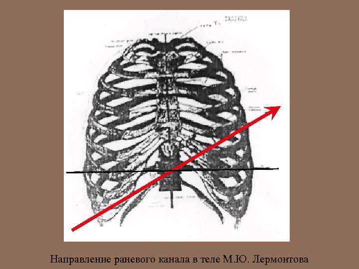 Направление раневого канала в теле М. Ю. Лермонтова 