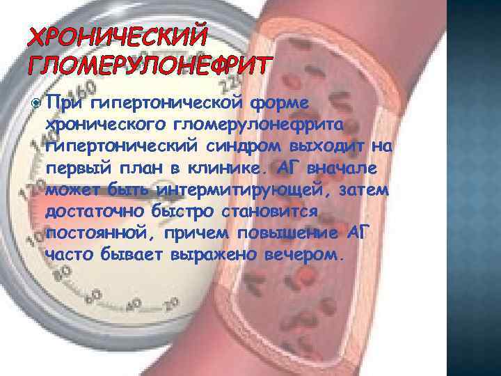ХРОНИЧЕСКИЙ ГЛОМЕРУЛОНЕФРИТ При гипертонической форме хронического гломерулонефрита гипертонический синдром выходит на первый план в