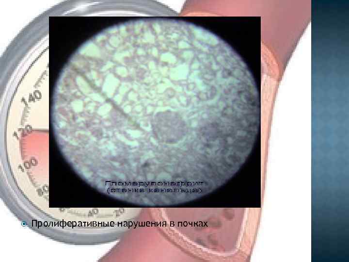  Пролиферативные нарушения в почках 