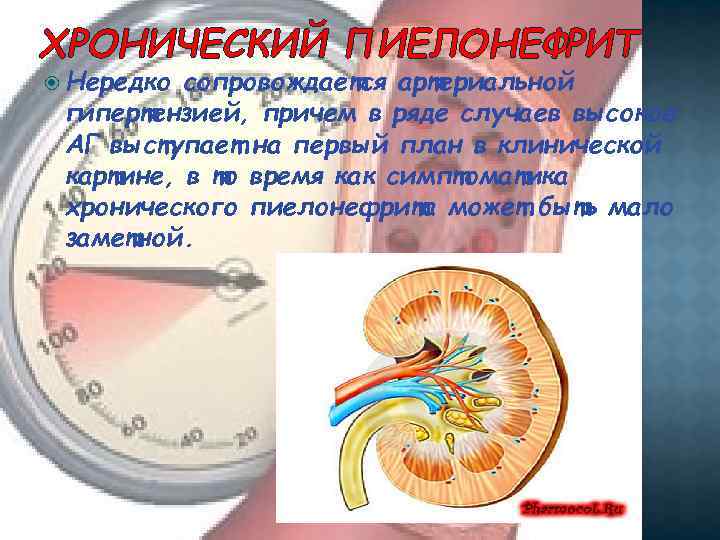 ХРОНИЧЕСКИЙ ПИЕЛОНЕФРИТ Нередко сопровождается артериальной гипертензией, причем в ряде случаев высокое АГ выступает на