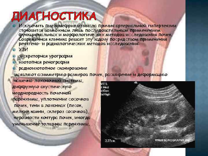 ДИАГНОСТИКА Исключить пиелонефрит из числа причин артериальной гипертензии становится возможным лишь последовательным применением функциональных