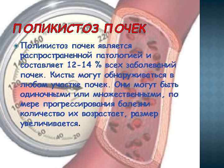 ПОЛИКИСТОЗ ПОЧЕК Поликистоз почек является распространенной патологией и составляет 12 -14 % всех заболеваний