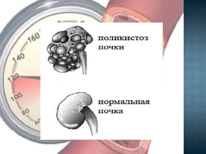 Почечная гипертония презентация