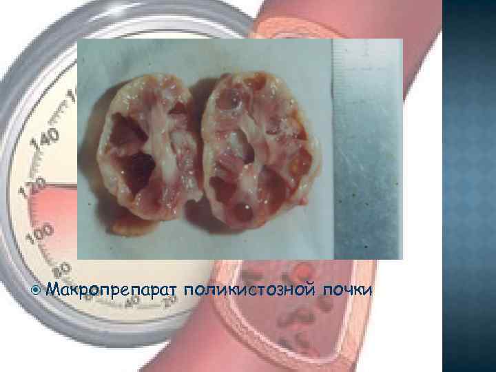  Макропрепарат поликистозной почки 