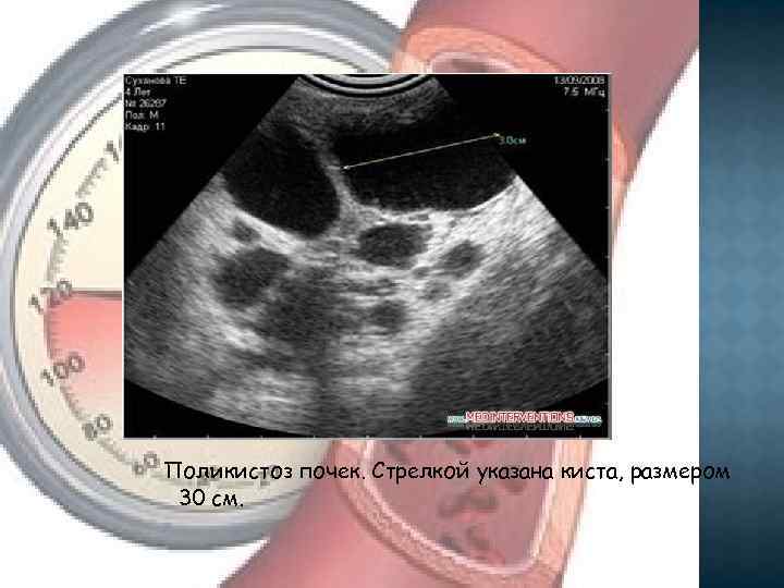 Поликистоз почек. Стрелкой указана киста, размером 30 см. 
