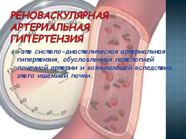 РЕНОВАСКУЛЯРНАЯ АРТЕРИАЛЬНАЯ ГИПЕРТЕНЗИЯ это систоло-диастолическая артериальная гипертензия, обусловленная патологией почечной артерии и возникающей вследствие
