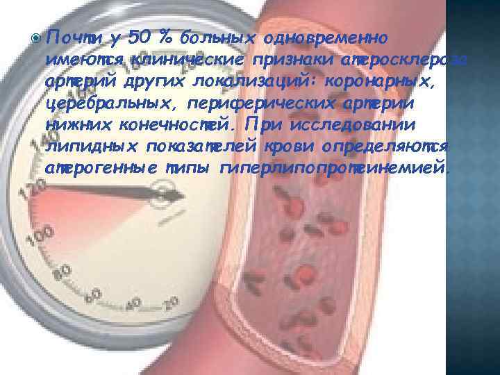  Почти у 50 % больных одновременно имеются клинические признаки атеросклероза артерий других локализаций: