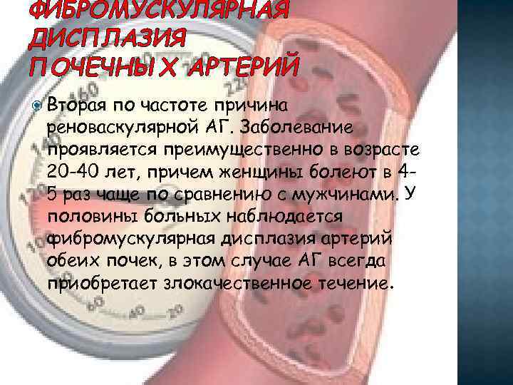 ФИБРОМУСКУЛЯРНАЯ ДИСПЛАЗИЯ ПОЧЕЧНЫХ АРТЕРИЙ Вторая по частоте причина реноваскулярной АГ. Заболевание проявляется преимущественно в