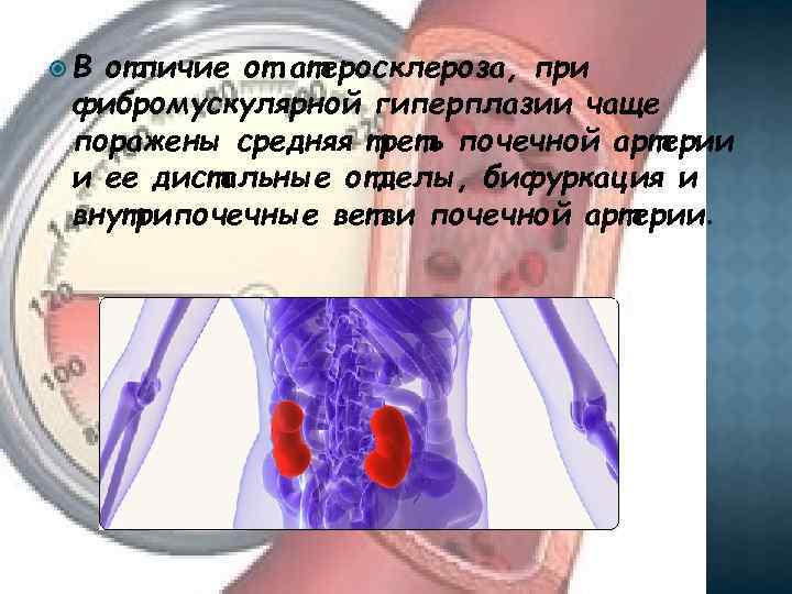  В отличие от атеросклероза, при фибромускулярной гиперплазии чаще поражены средняя треть почечной артерии