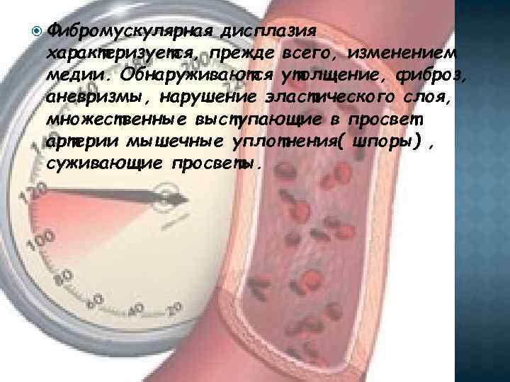  Фибромускулярная дисплазия характеризуется, прежде всего, изменением медии. Обнаруживаются утолщение, фиброз, аневризмы, нарушение эластического