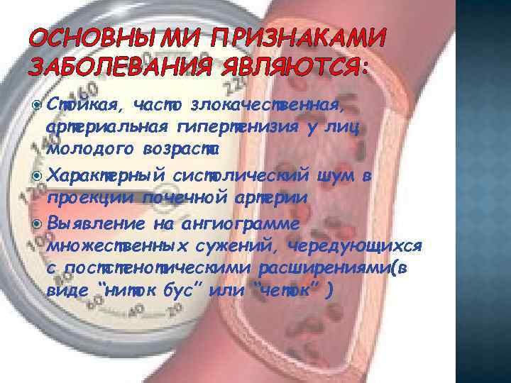 ОСНОВНЫМИ ПРИЗНАКАМИ ЗАБОЛЕВАНИЯ ЯВЛЯЮТСЯ: Стойкая, часто злокачественная, артериальная гипертенизия у лиц молодого возраста Характерный