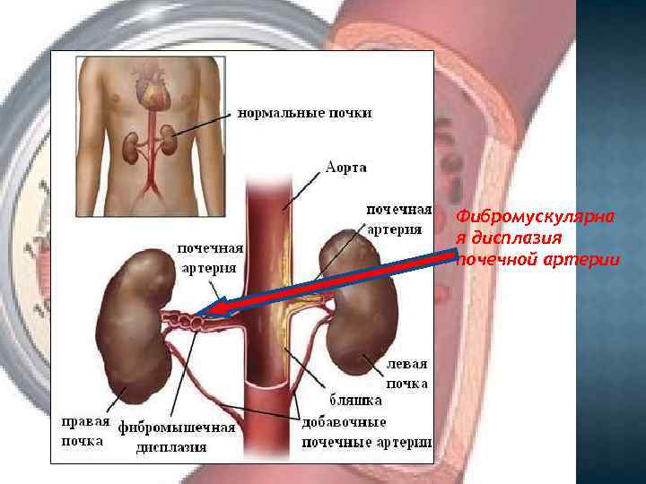 Фибромускулярна я дисплазия почечной артерии 