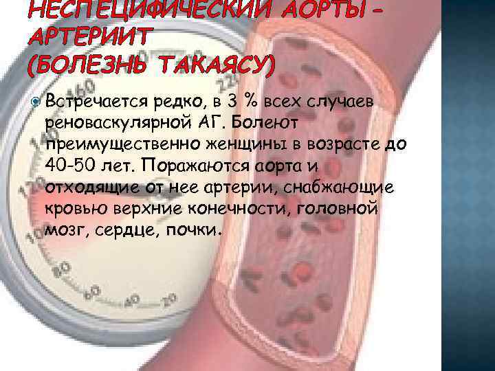 НЕСПЕЦИФИЧЕСКИЙ АОРТЫАРТЕРИИТ (БОЛЕЗНЬ ТАКАЯСУ) Встречается редко, в 3 % всех случаев реноваскулярной АГ. Болеют