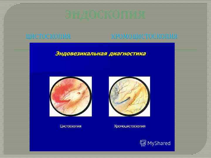 ЭНДОСКОПИЯ ЦИСТОСКОПИЯ ХРОМОЦИСТОСКОПИЯ 