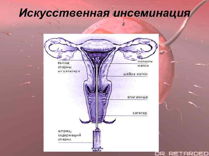 Искусственная инсеминация 