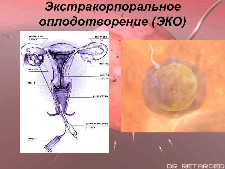 Экстракорпоральное оплодотворение (ЭКО) 