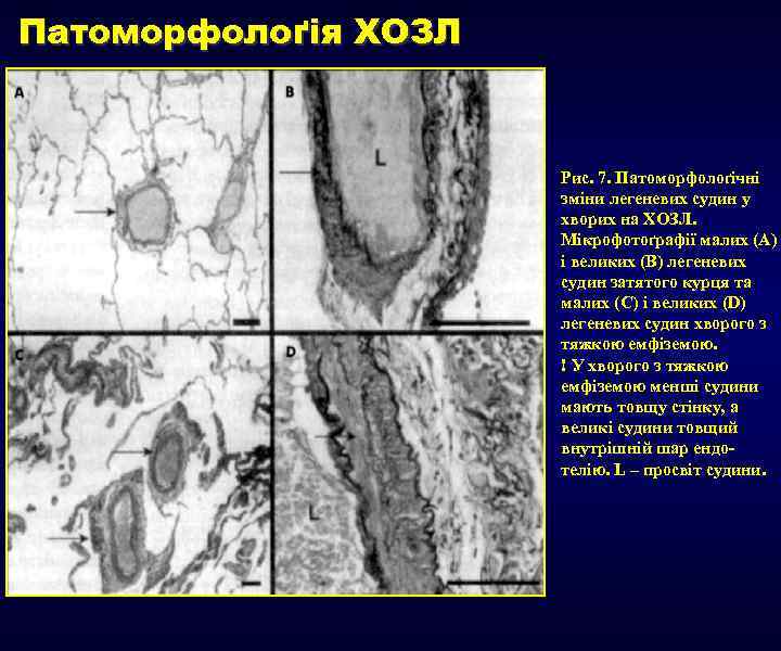 Патоморфолоґія ХОЗЛ Рис. 7. Патоморфолоґічні зміни легеневих судин у хворих на ХОЗЛ. Мікрофотоґрафії малих
