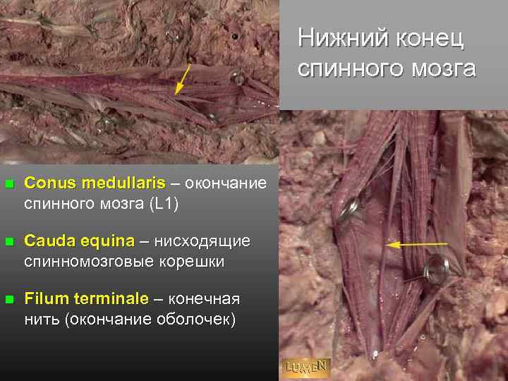 Клиническая картина компрессии корешков конского хвоста отличается от компрессии конуса и эпиконуса