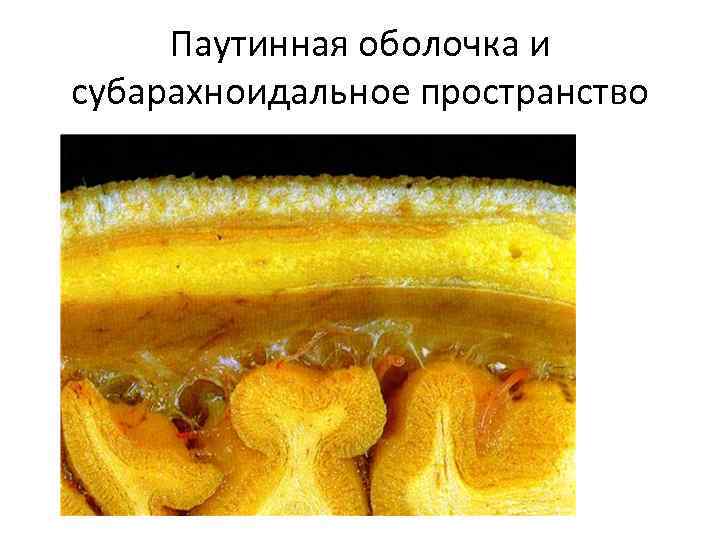 Паутинная оболочка и субарахноидальное пространство 