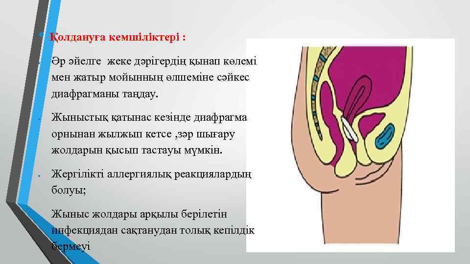  • Қолдануға кемшіліктері : Әр әйелге жеке дәрігердің қынап көлемі мен жатыр мойынның