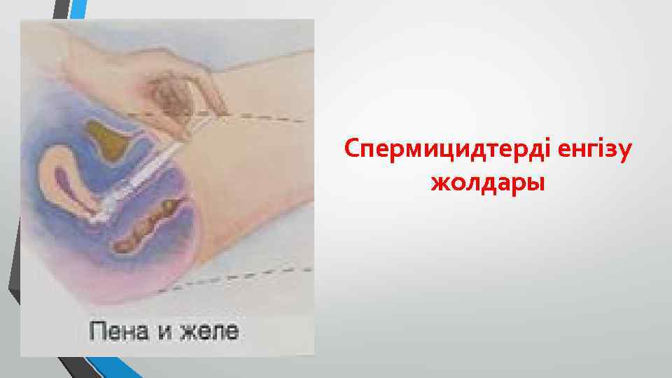 Спермицидтерді енгізу жолдары 
