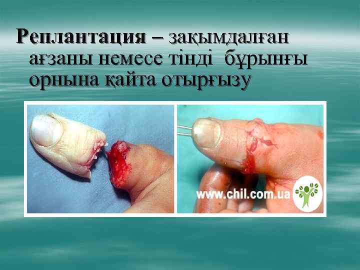 Реплантация – зақымдалған ағзаны немесе тінді бұрынғы орнына қайта отырғызу 