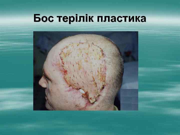 Бос терілік пластика 