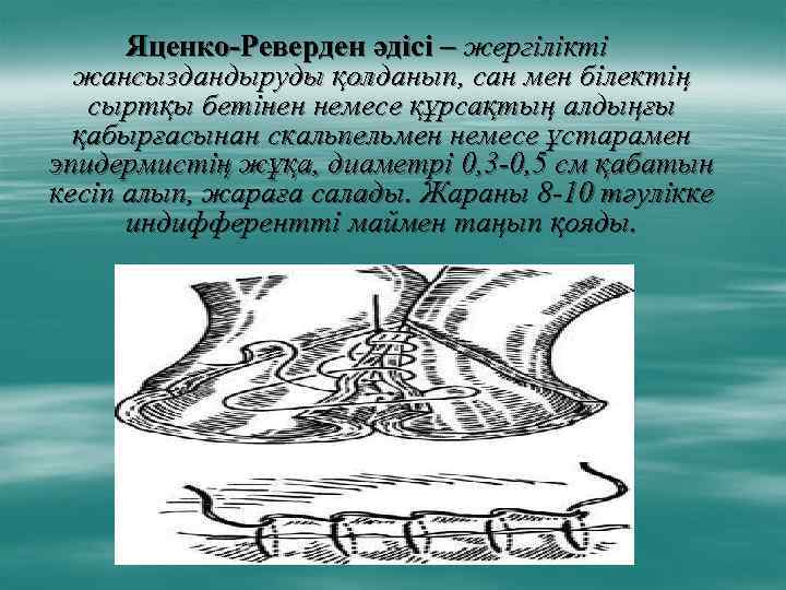 Яценко-Реверден әдісі – жергілікті жансыздандыруды қолданып, сан мен білектің сыртқы бетінен немесе құрсақтың алдыңғы