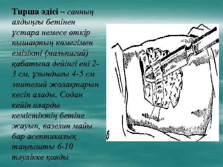 Тирша әдісі – санның алдыңғы бетінен ұстара немесе өткір пышақтың көмегімен емізікті (мальпигий) қабатына