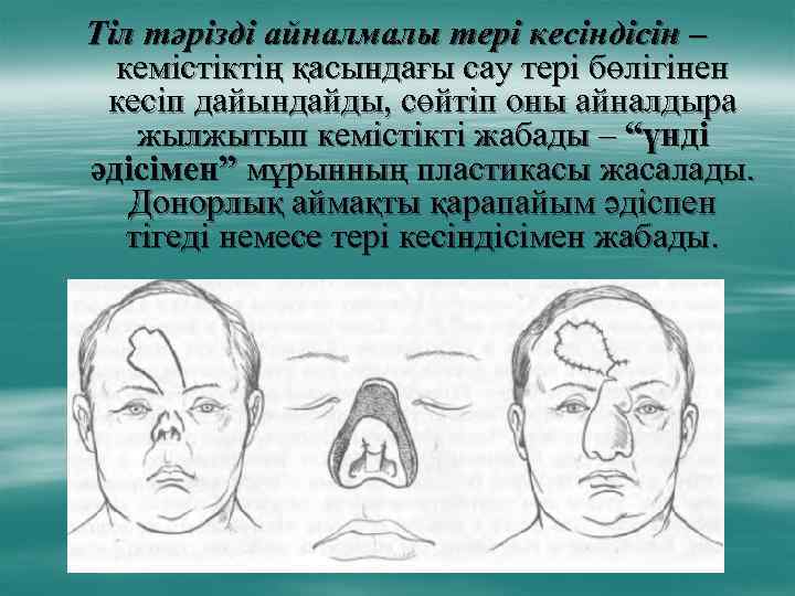 Тіл тәрізді айналмалы тері кесіндісін – кемістіктің қасындағы сау тері бөлігінен кесіп дайындайды, сөйтіп