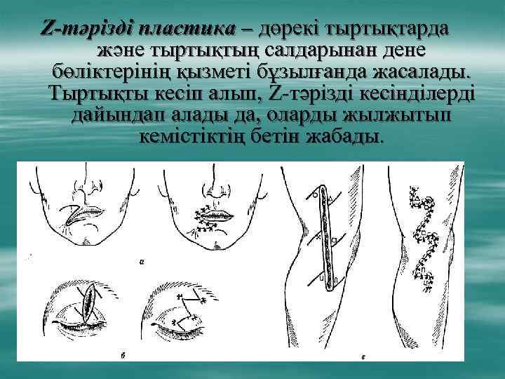 Z-тәрізді пластика – дөрекі тыртықтарда және тыртықтың салдарынан дене бөліктерінің қызметі бұзылғанда жасалады. Тыртықты