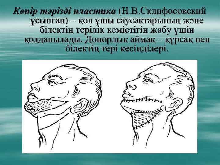 Көпір тәрізді пластика (Н. В. Склифосовский ұсынған) – қол ұшы саусақтарының және білектің терілік