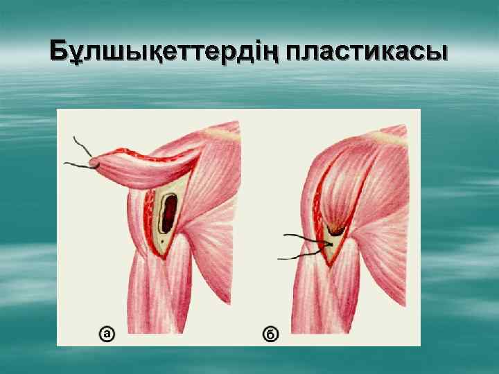 Бұлшықеттердің пластикасы 