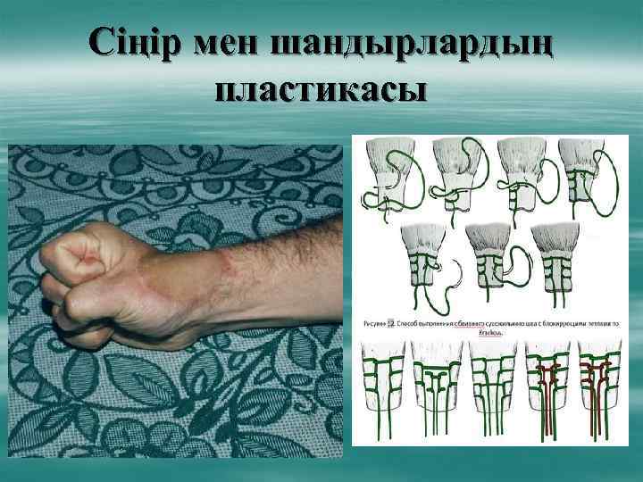 Сіңір мен шандырлардың пластикасы 