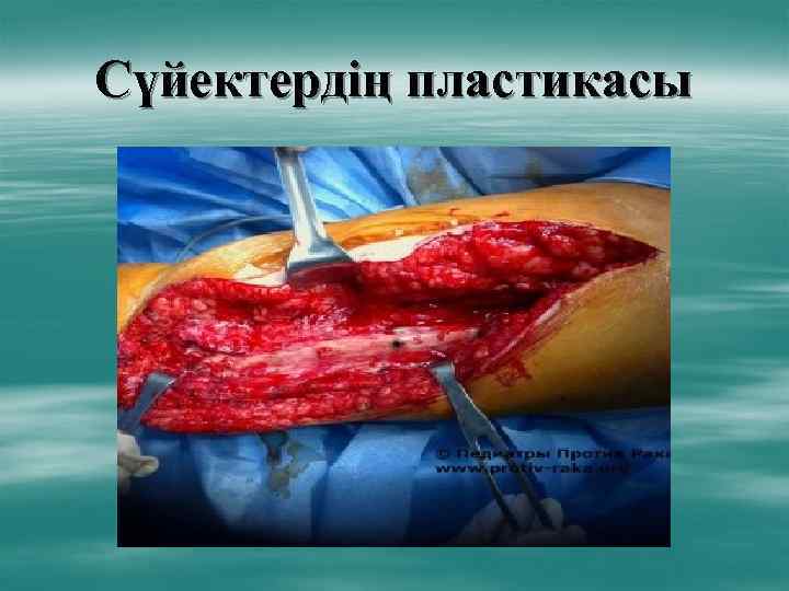 Сүйектердің пластикасы 