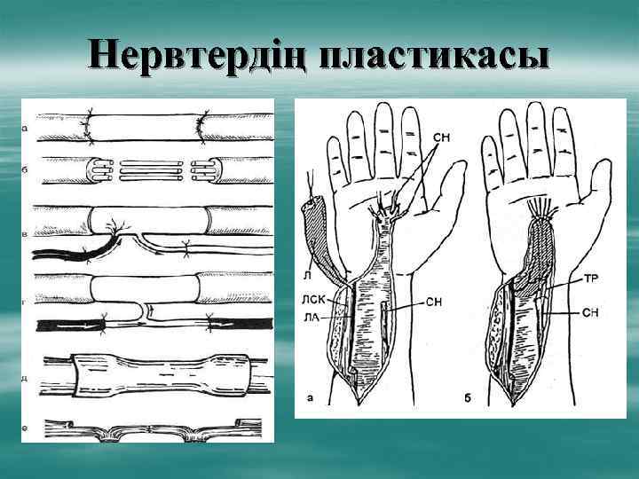 Нервтердің пластикасы 