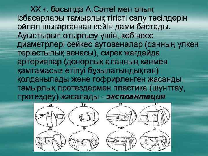 ХХ ғ. басында А. Carrel мен оның ізбасарлары тамырлық тігісті салу тәсілдерін ойлап шығарғаннан