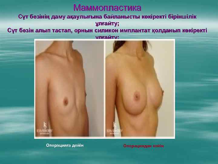 Маммопластика Сүт безінің даму ақаулығына байланысты көкіректі біріншілік ұлғайту; Сүт безін алып тастап, орнын