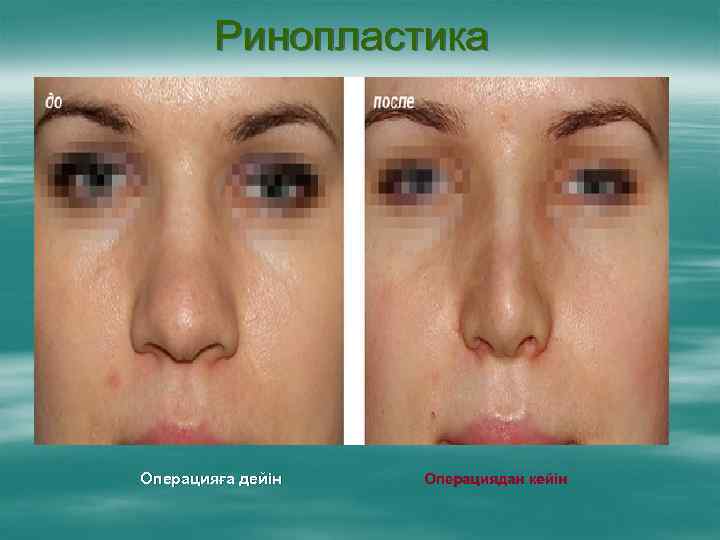 Ринопластика Операцияға дейін Операциядан кейін 