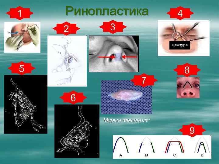 1 Ринопластика 4 3 2 5 7 8 6 Мұрын төмпешігі 9 
