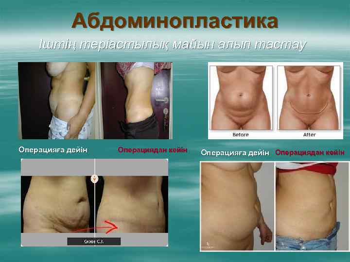 Абдоминопластика Іштің теріастылық майын алып тастау Операцияға дейін Операциядан кейін 