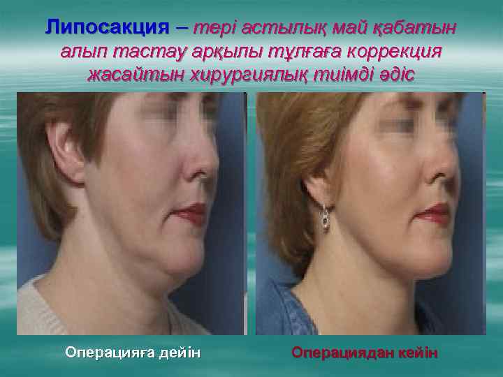 Липосакция – тері астылық май қабатын алып тастау арқылы тұлғаға коррекция жасайтын хирургиялық тиімді