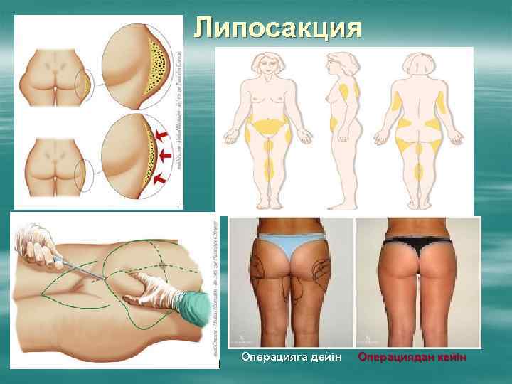 Липосакция Операцияға дейін Операциядан кейін 