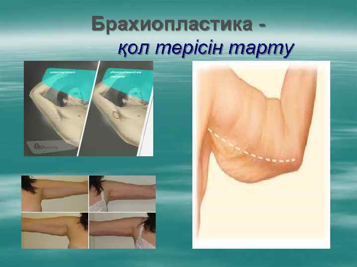 Брахиопластика қол терісін тарту 