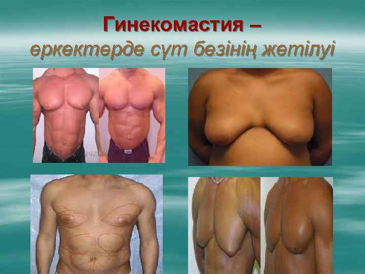 Гинекомастия – еркектерде сүт безінің жетілуі 