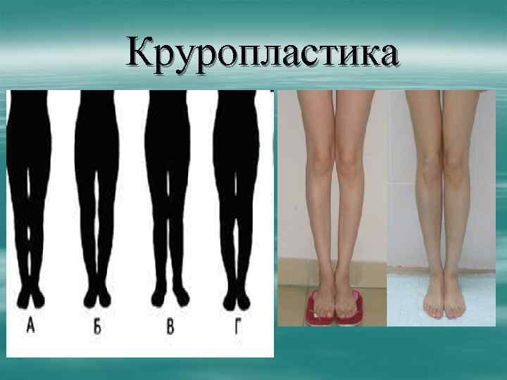 Круропластика 