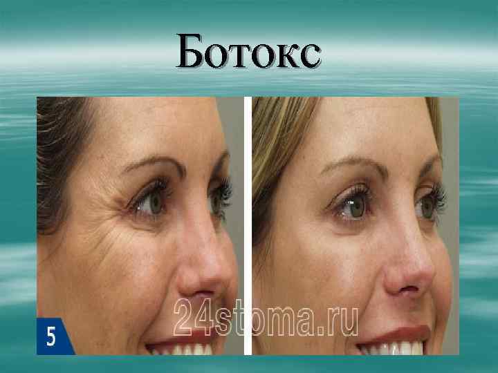 Ботокс 