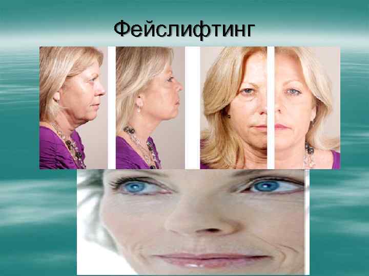 Фейслифтинг 